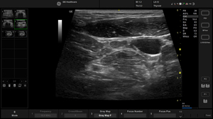 active-l612-thyroid-lymphnode_1.jpg