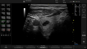 active-l612-thyroid-virtual-convex.jpg