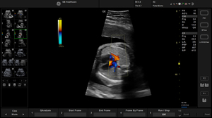 active-ob-color-fetal-heart_2.jpg